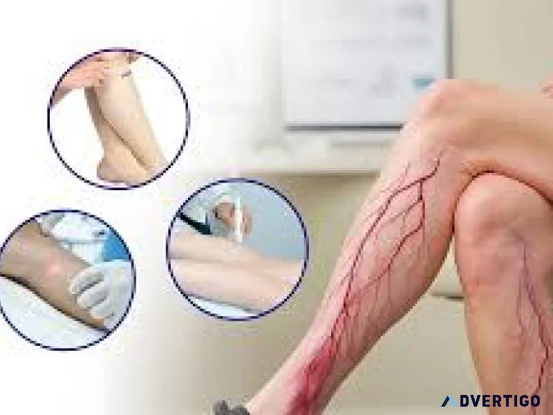 Effective and painless varicose vein treatment in pune
