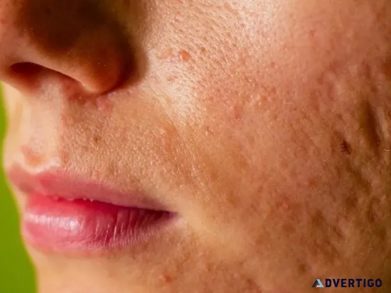 Open pores treatment