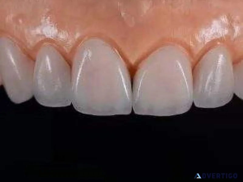 E max teeth manufacturer – get 20% off on bulk orders