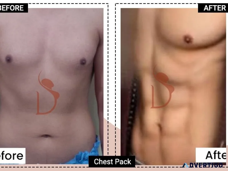 Six pack abs surgery | sculpted abs with advanced abdominal etch