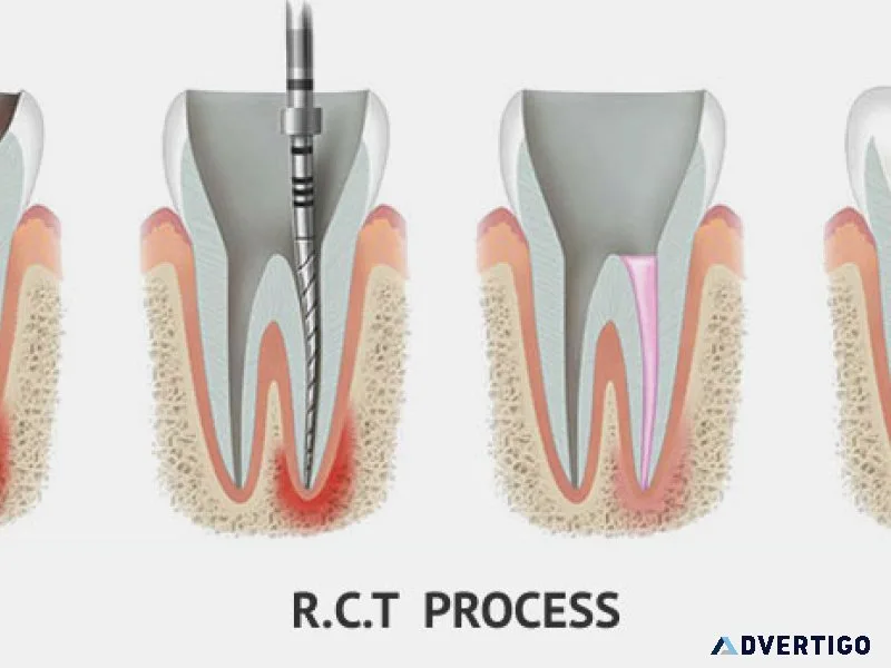 Save your tooth – advanced root canal treatment in noida