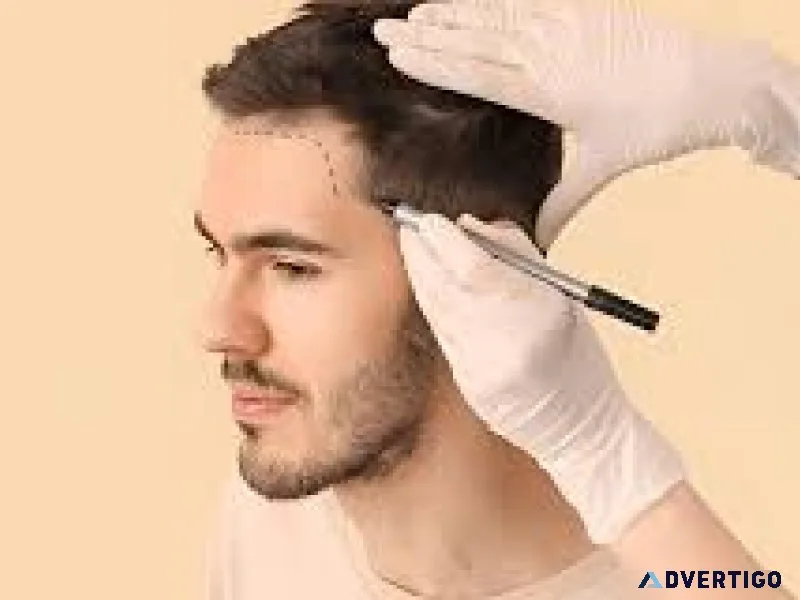 Best hair transplant cost in chandigarh