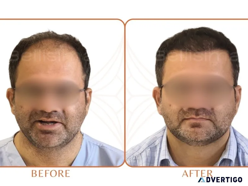 Best hair transplant in ahmedabad | bellisima hair transplant cl