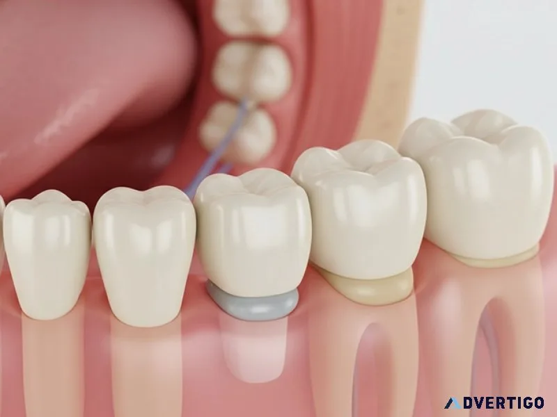Best dental crowns & bridges treatment in alwarpet