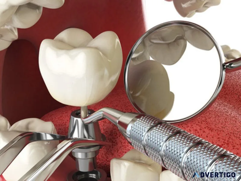 Affordable root canal treatment cost in delhi with expert care