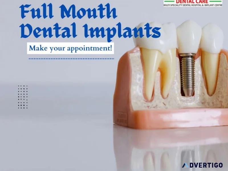 Full month dental implants your complete guide to a permanent