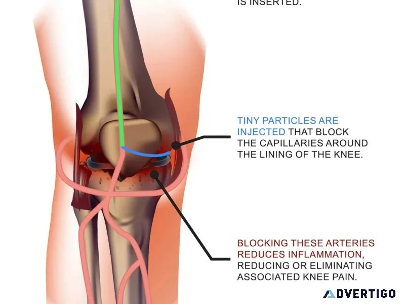Genicular artery role in knee blood supply and modern treatment