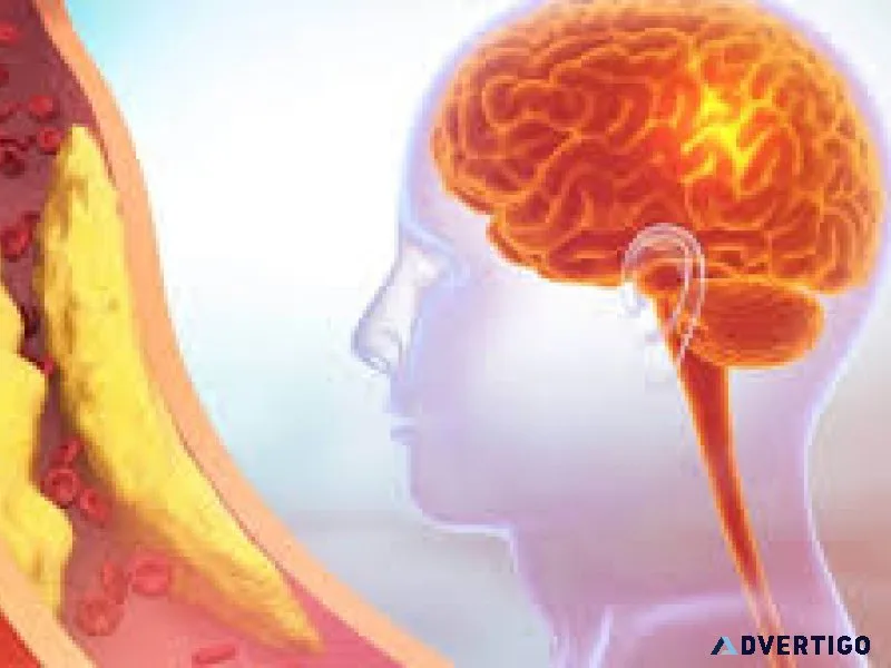 Carotid artery stenosis causes risks and treatment options