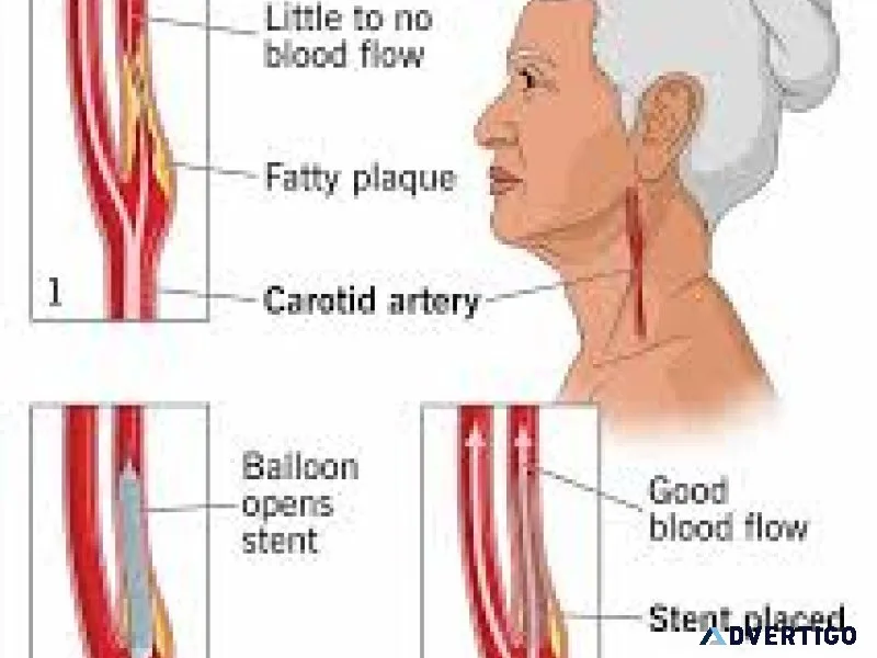Benefits of carotid artery stenting in india