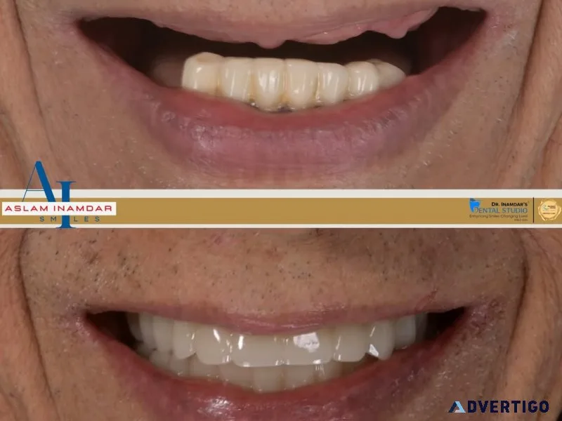 Scared of pain dental implants are easier than you think