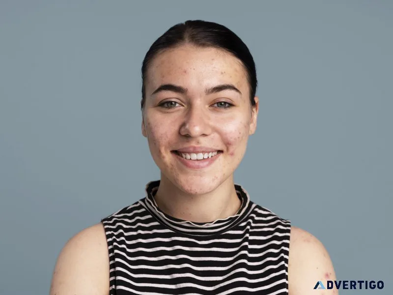 Clear skin starts with the right acne treatment