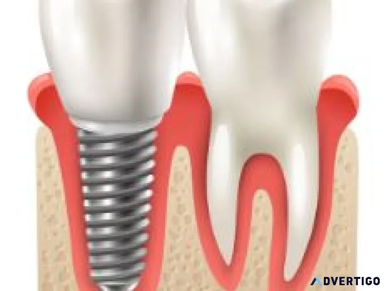 Dental implant treatment in silchar advanced care by dento der