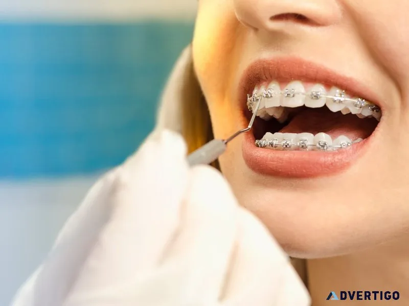Teeth braces near me braces treatment in pune dr sonali