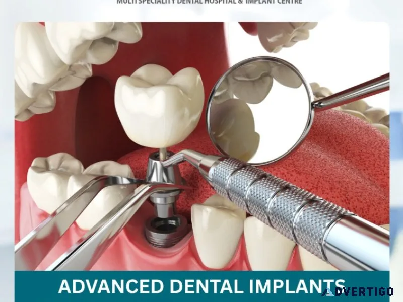 Advanced dental implants treatment vanasthalipuram clinic