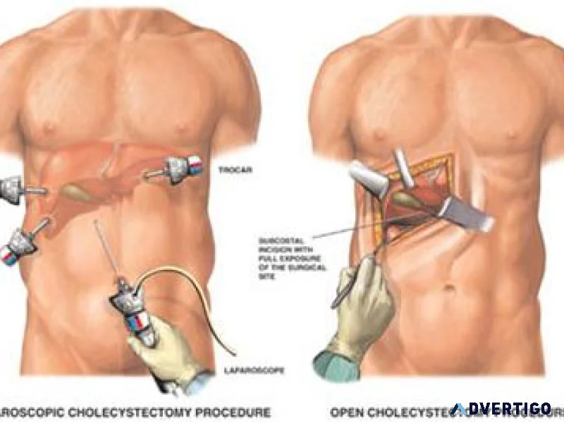 Gallbladder stone treatment in delhi by dr neeraj goel