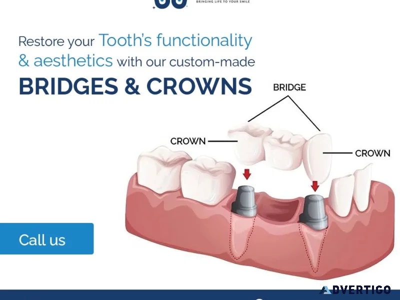 Advanced dental implants at the best dental clinic in kondapur