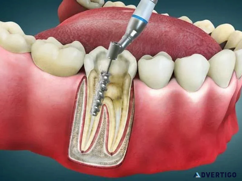 Why advanced painless root canal treatment with microscopic