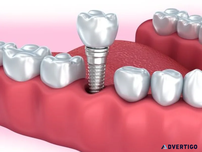 Expert implants for missing teeth in pune by dr hileri mori