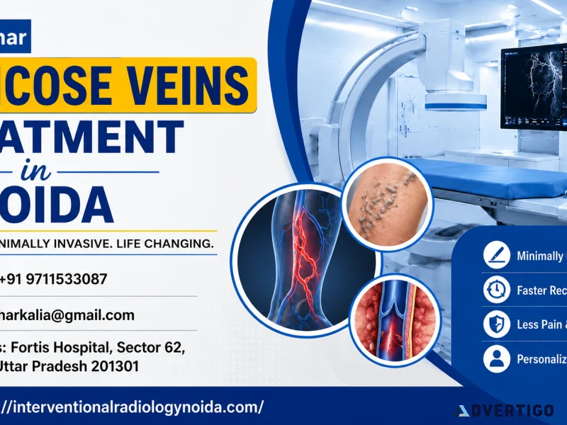 Varicose veins treatment in noida