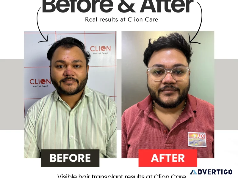 Hair transplant cost in vadodara affordable hair restoration