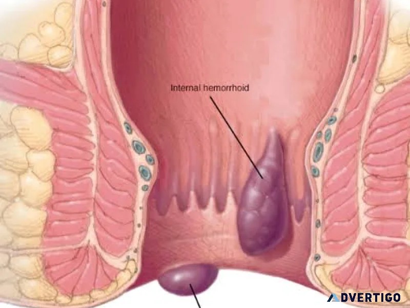 Expert piles surgeon in delhi advanced piles care