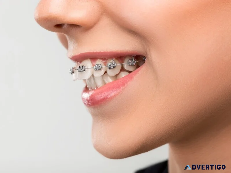 Dental implants fort worth restore your smile with confidence