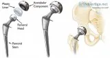 Get total hip replacement surgery at jai