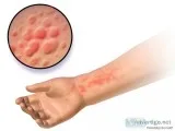Get rid-of your hives naturally