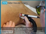 Varicose veins best treatment in india
