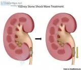 Shockwave Lithotripsy (ESWL)