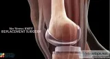 Knee Surgery Treatment View Cost Book Appointment