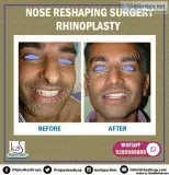 Are You A Good Candidate for Rhinoplasty Surgery