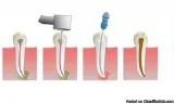 Save Your Badly Decayed or Infected Tooth With Root Canal
