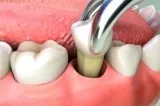 Effective Treatment for Wisdom Teeth Removal