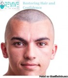 Top Hair Transplant in UK - Revive Hair and Skin Clinic