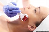 Micro-needling and Dermapen