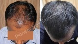 Hair Loss Treatment in Bangalore-Hair Loss Therapy