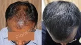 Hair Loss Treatment in Bangalore-Hair Loss Therapy