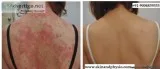 BEST TREATMENT FOR PSORIASIS