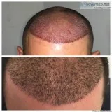 Best Hair Loss Medication Clinic in the UK