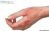 Burn Rehabilitation in Chennai  JH Rehabilitation