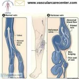 Varicose Veins Treatment In Hyderabad  Vascular Care Center