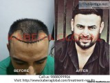 Reasonable Hair Transplant Cost in Jalandhar to Restore Hair