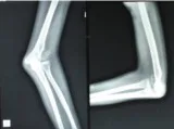 Treatment of neglected femoral neck fracture
