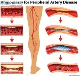 Angioplasty in Mumbai (with Cost) -medicaltreatmentcos t.com