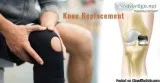 Knee Replacement Surgery Specialist in India - Health and Hopes