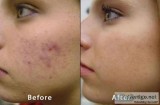 Microdermabrasion