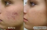 Microdermabrasion