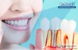 Gold Teeth Prices in India