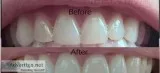 Tooth Extraction